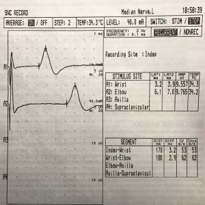 Électromyographe (EMG)